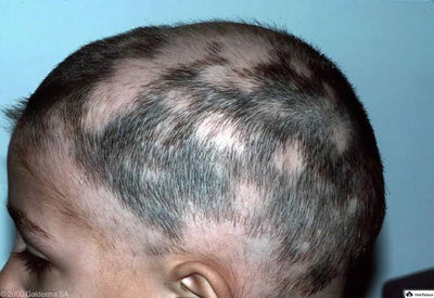 Alopecia areata