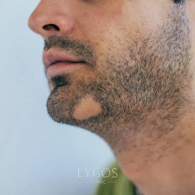 Alopecia barbae