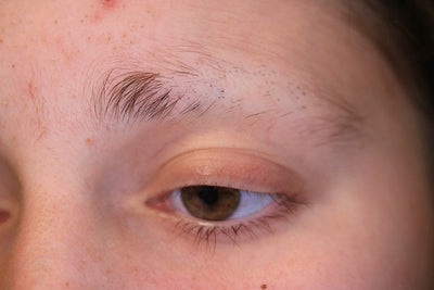 Eyebrow alopecia