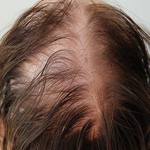 Female hair baldness