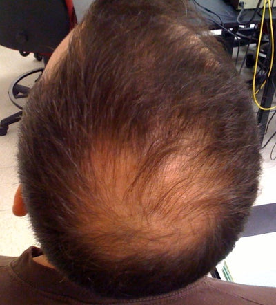 Scalp baldness