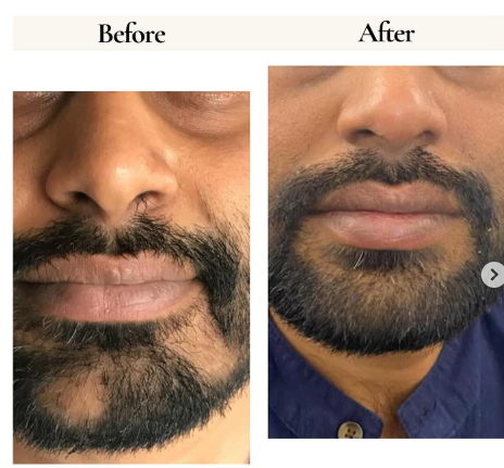 Before and after hair regrowth result 1