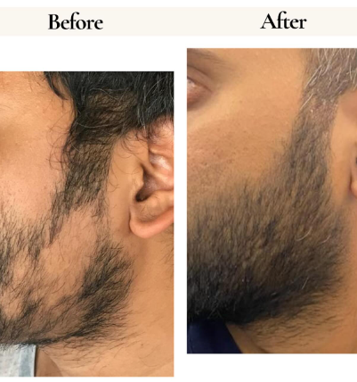 Before and after hair regrowth result 6