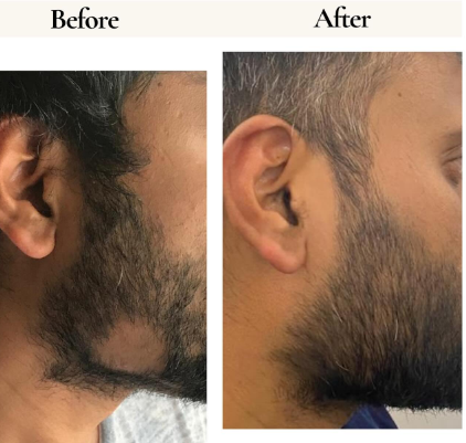 Before and after hair regrowth result 2