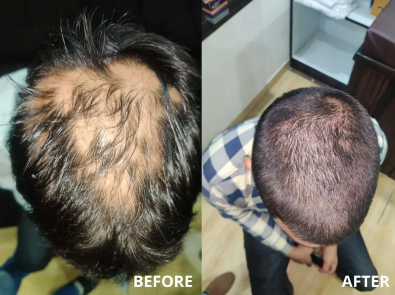 Before and after hair regrowth result 3