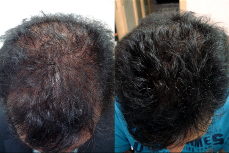 Before and after hair regrowth result 5