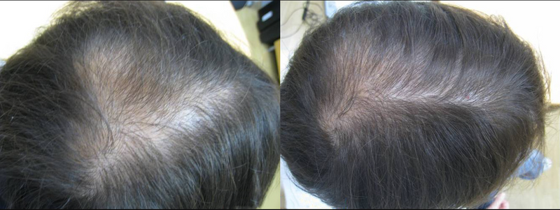 Before and after hair regrowth result 4