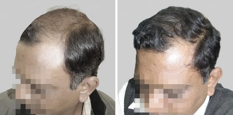 Before and after hair regrowth result 8